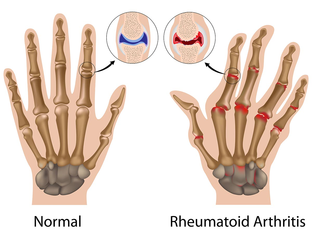 <p>An <strong>autoimmune disease</strong> in which the <strong>immune system attacks the joints</strong>, causing <strong>inflammation, pain, and swelling</strong>.</p>