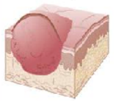 <p>means swelling</p><p>solid mass<span style="color: red;"><strong> larger than 1cm</strong></span></p><p>abnormal growth of tissue, can be benign or malignant.</p>