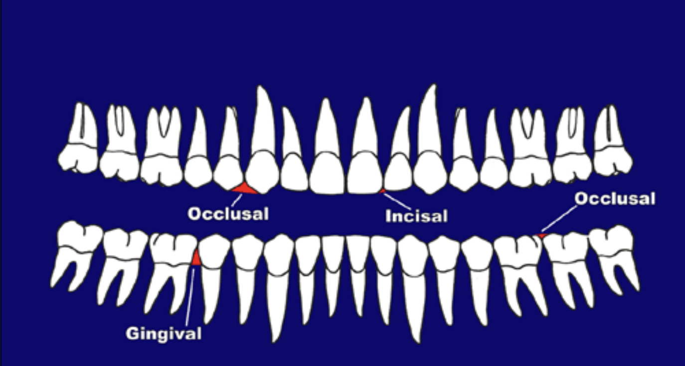 <p>What embrasures are evident from a Facial/Buccal Viewpoint? </p>