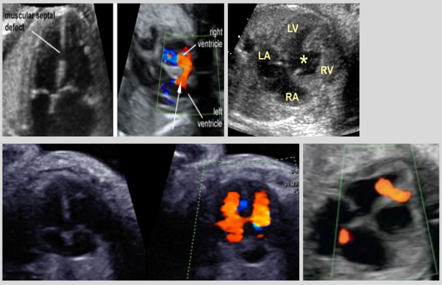 <ul><li><p><span style="background-color: transparent;">Most common congenital heart defect (1/400 cases)</span></p></li><li><p><span style="background-color: transparent;">Abnormal connection between RV and LV</span></p></li><li><p><span style="background-color: transparent;">US findings:</span></p><ul><li><p><span style="background-color: transparent;">Defect in the interventricular septum (IVS)</span></p></li><li><p><span style="background-color: transparent;">Blood shunts between ventricles w/ color Doppler</span></p></li></ul></li></ul><p></p>