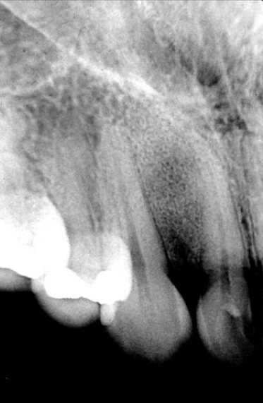 <p>what trabecular pattern is this?</p>