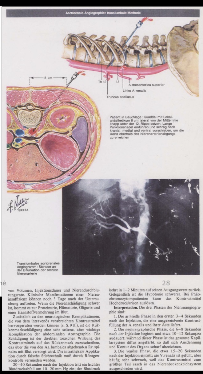 <p>Aorta descendens punkcija – tikslios koordinatės</p>