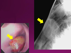 <p>On endoscopy, you see this green to yellow, purple to red mass with a smooth surface. What is your first thought?</p>