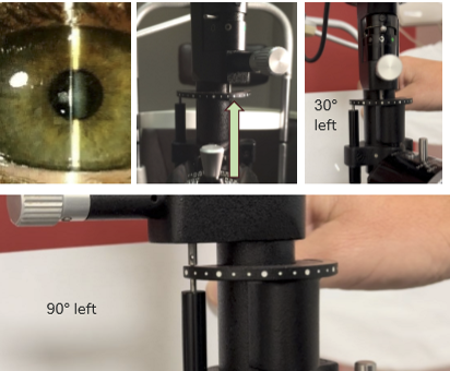 <ul><li><p>Create a vertical, tall, narrow beam.</p></li><li><p>Align the beam with the toric lens marking.</p></li><li><p>Rotate the slit lamp tower until the beam matches the mark.</p></li><li><p>Read the amount and direction of rotation using the slit lamp scale.</p></li><li><p>Apply LARS if the rotation is clinically significant.</p></li></ul><p></p>