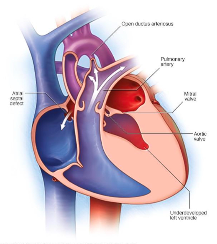 <p>what treatment options are available for <strong>hypoplastic left heart syndrome</strong>?</p>