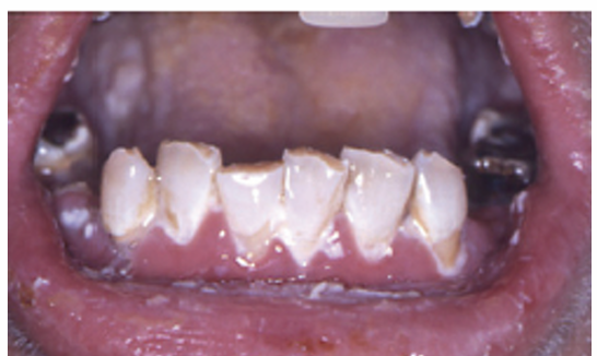 <p>1.what is this lesion?</p><p>2. how to treat/ manage it?</p><p>3. classification of oral lesion in HIV?</p>