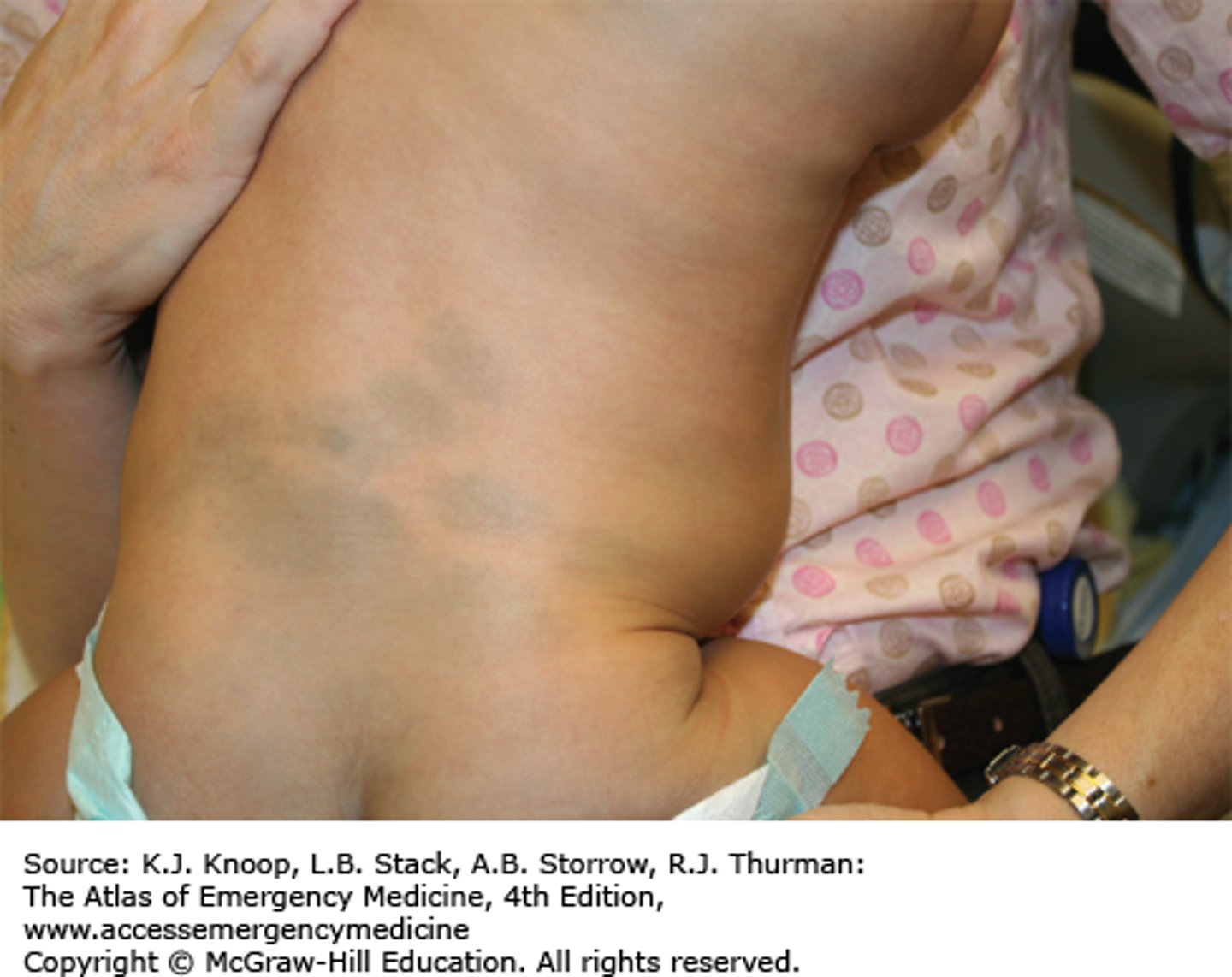 <p>blue-grey or brown macules, usually over spine and buttocks. More typical in babies of African or Asian decent</p>