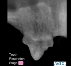 <p>what stage of tooth resorption is this?</p>
