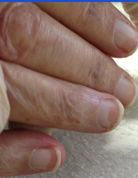 <p>Transverse white nail bands with a distal brown arc; associated with aging, diabetes, heart failure, and liver disease.</p>