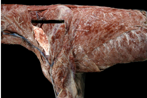 <ol><li><p>Origin</p></li></ol><p>wing of atlas</p><ol start="2"><li><p>Insertion</p></li></ol><p>spine and acromion of scapula</p><ol start="3"><li><p>Action</p></li></ol><p>advances leg </p><p></p>