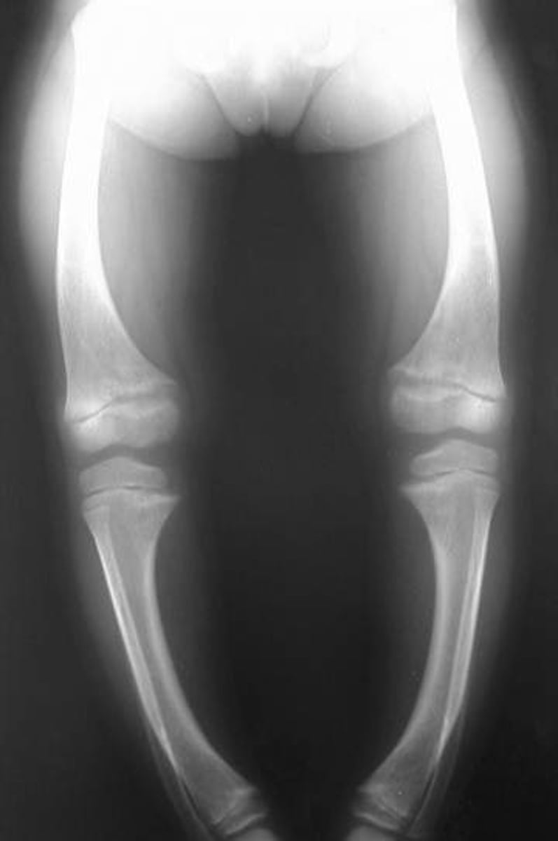 <p>softening of bone, with inadequate amounts of mineral (calcium) in the bone - seen in vitamin D deficiency - known as rickets in children</p>