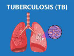 <p><span style="background-color: transparent;">tuberculosis (TB)</span></p>