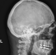 <p><span style="background-color: transparent;">Lateral skull</span></p>