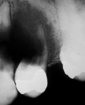 <p>ill-defined peripheral borders seen in osteosarcoma </p>