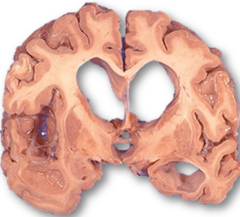 <p>What is communicating hydrocephalus?</p>