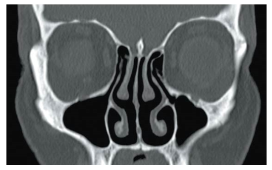 <p>3 bony projections of the nasal cavity that curl around three narrow passages</p><ul><li><p>Superior conchae</p><ul><li><p>Curl around the superior meatus</p></li></ul></li><li><p>Middle conchae</p><ul><li><p>Curl around the middle meatus</p></li></ul></li><li><p>Inferior conchae</p><ul><li><p>Curl around the inferior meatus</p></li></ul></li><li><p>Functions:</p><ul><li><p>Create turbulence in the airflow, slowing it down so air can be warmed and rid of dust and debris</p></li><li><p>Lots of hairs present to trap debris</p></li></ul></li></ul><p></p>