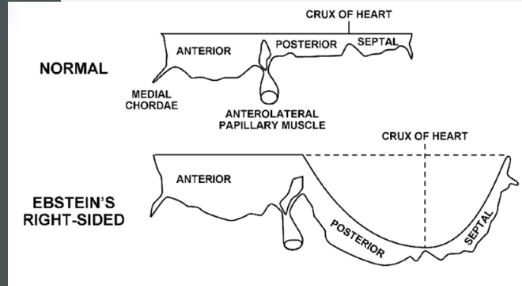 <p>The tricuspid valve fails to properly <strong>delaminate</strong>, or separate, from the inner wall of the right ventricle.</p><p>This causes one or more leaflets to become apically displaced. The anterior leaflet becomes long and sail-like and may spiral toward the RVOT.</p><p></p><p><strong>Delaminate</strong> means the valve leaflet is supposed to <strong>separate/free itself from the RV wall</strong> during development.<br>But in Ebstein’s, it does <strong>not separate normally</strong>, so parts of the tricuspid valve stay stuck/tethered too low in the RV.</p>