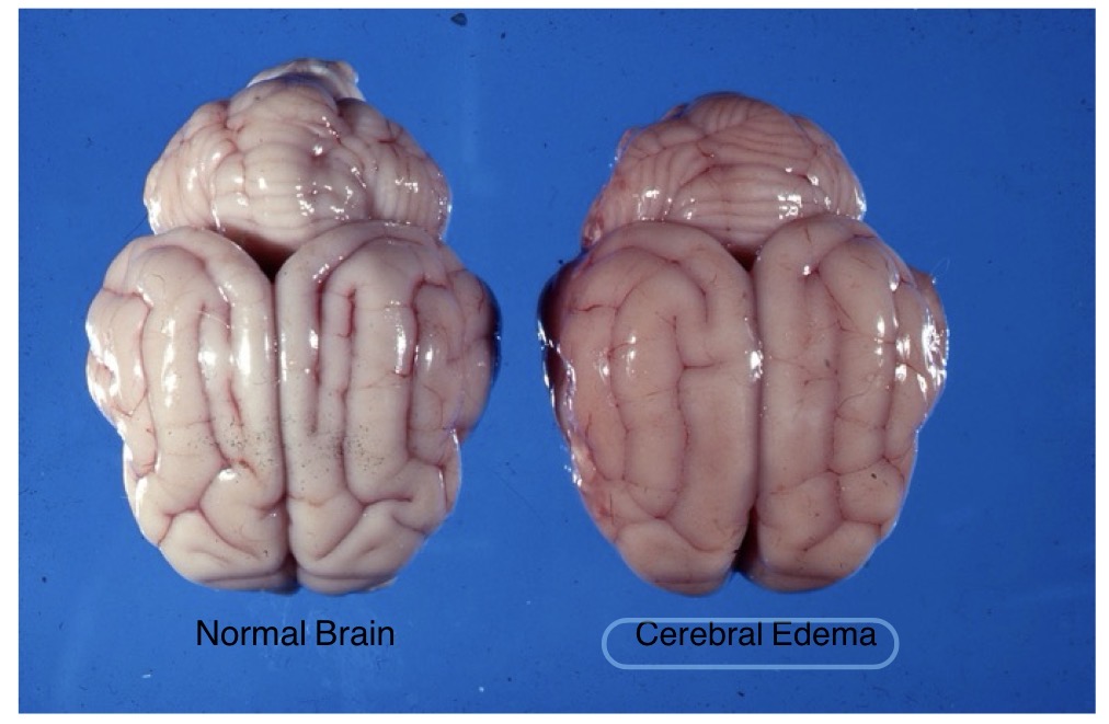 <ul><li><p>lesion: cerebral edema</p></li><li><p>observations:</p><ul><li><p>widened gyri</p></li><li><p>less apparent sulci</p></li><li><p>diffusely swollen appearance</p></li></ul></li></ul><p></p>
