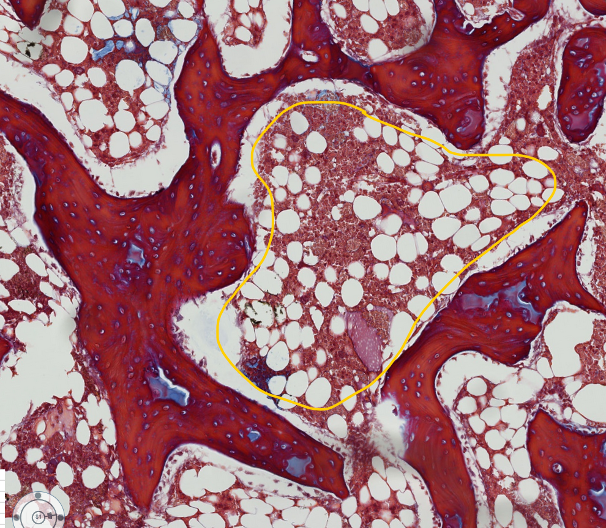 <p><span style="font-family: "Calibri Light";">The encircled tissue is bone marrow, surrounded by bone spicules.<br><br>What do you think the clear spaces are? Hint: it is a type of adult CT proper</span></p>