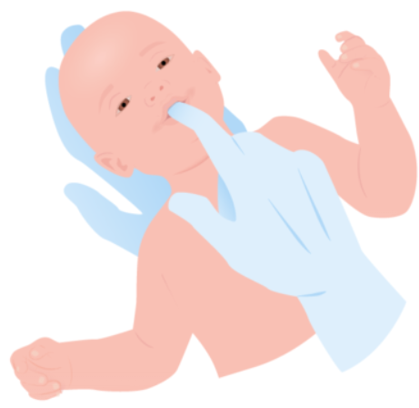 <ul><li><p>primitive reflex - brainstem</p></li><li><p>prerequisite for speech and head control, develops oral muscles, tongue placement, swallowing, inhibits gag reflex</p></li><li><p>stimulate with finger or nipple in baby’s mouth => sucking</p></li></ul><p></p>