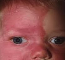 <p>Facial hemangioma seen in Sturge Weber syndrome is present at birth following the distribution of...</p>