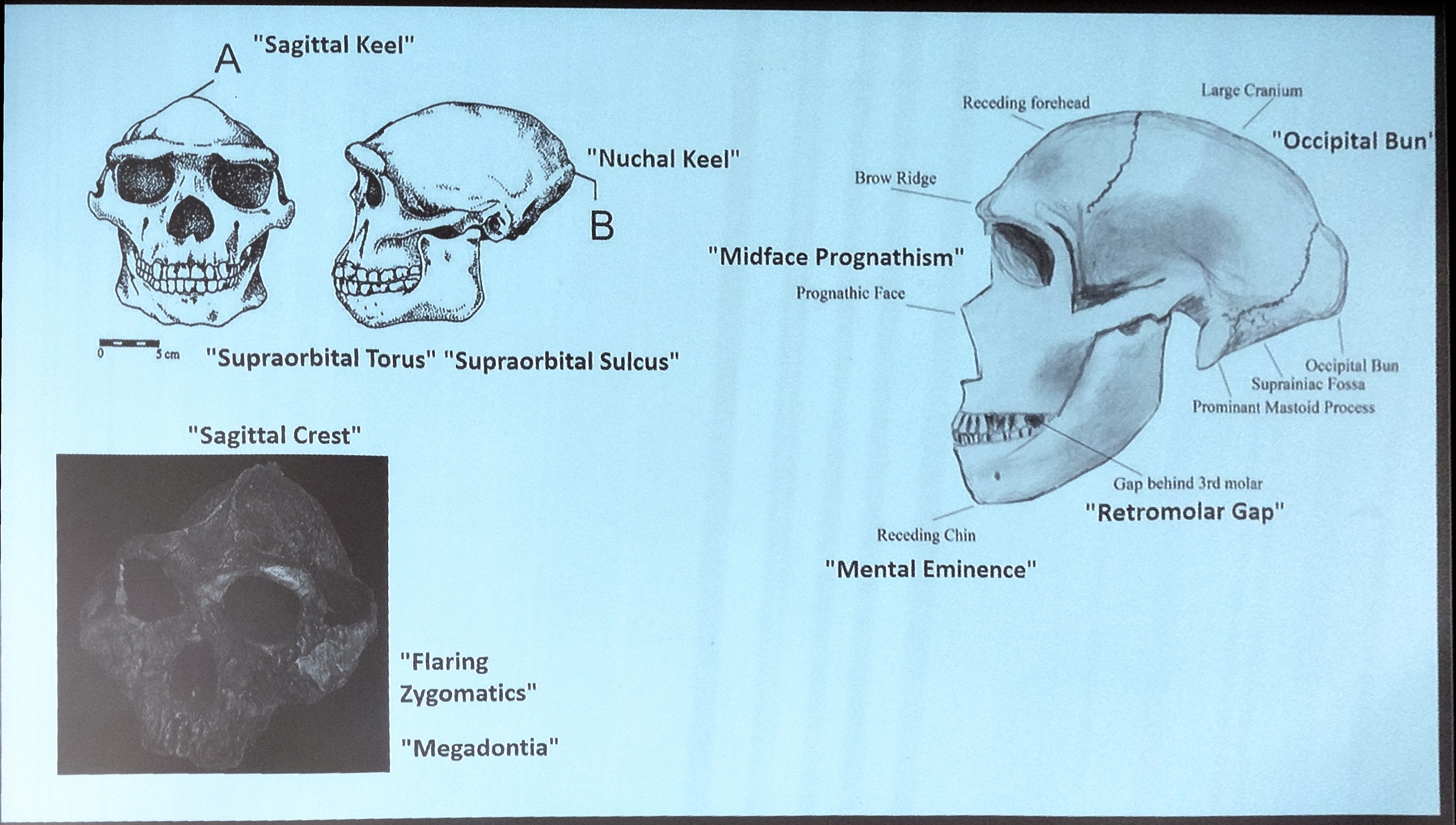 <p>Sagittal keel: veryyyy subtle slightly raised ridge of bone at the top of the skull</p><p>Nuchal keel/torus: veryyyy slight protuberance at the back of the skull</p><p>Supraorbital torus: above orbital (eye) protuberance = brow ridge</p><p>Suproaorbital sulchis: above orbital (eye) depression = below brow ridge</p><p>Sagittal crest</p><p>Flaring zygomatics: prominent cheek bones</p><p>Megadontia: large teeth</p><p>Midface prognathism: middle of face protrudes somewhat</p><p>Occipital bun: creates football shaped head</p><p>Retromolar gap: space behind the third molar</p><p>Mental eminence: chin!!</p>