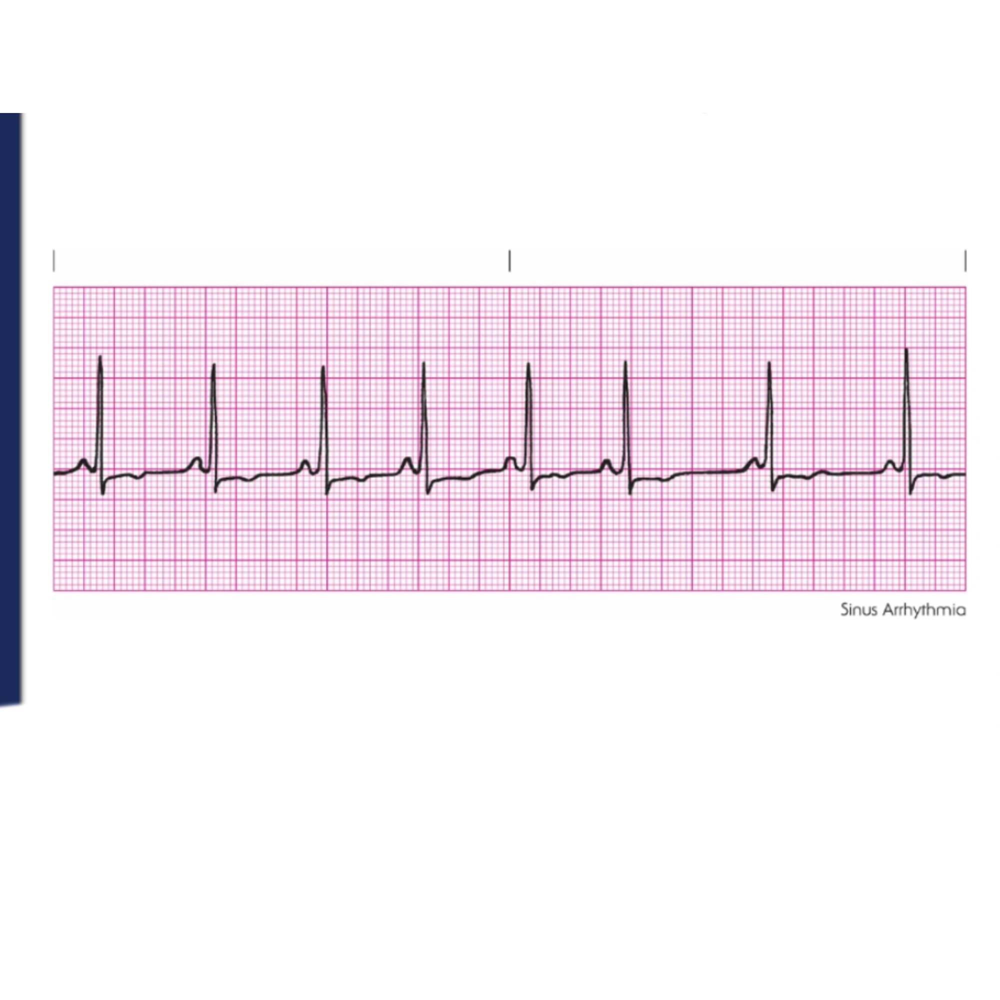 <p>Rules for Sinus Arrhythmia includes</p>