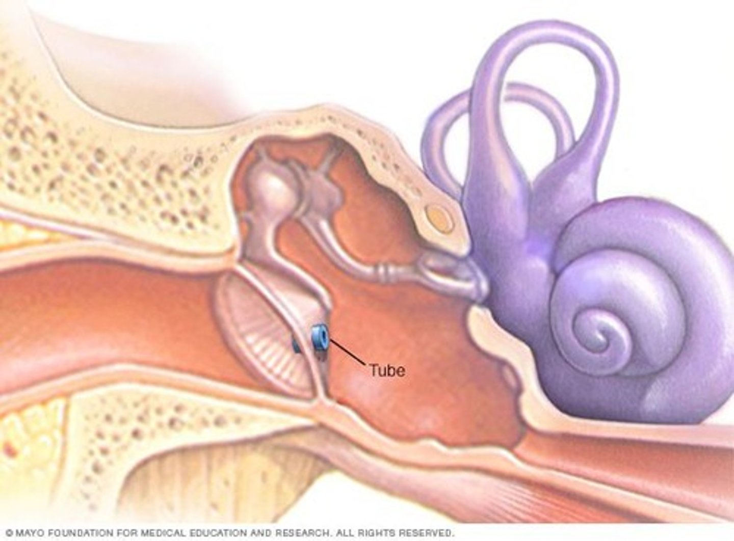 <p>Ventilating tubes inserted into the eardrum for drainage and pressure relief</p>