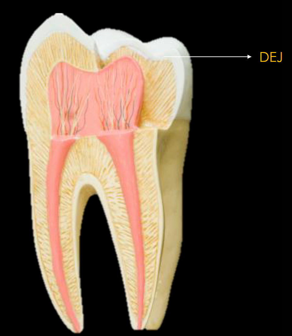 <p>Where enamel meets dentin </p>