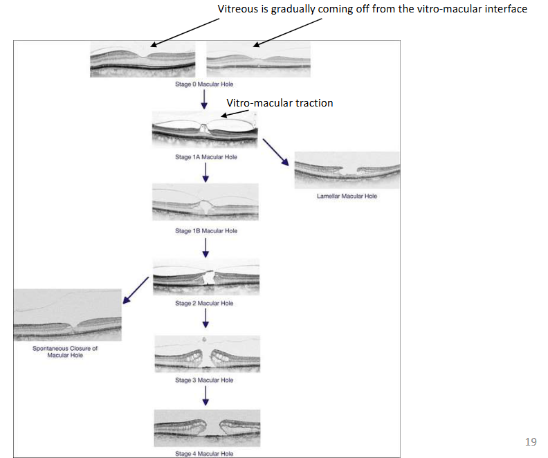 <p>Stage 1: Vitreous has come off in parts + little bit of pull</p><p>Stage 1A=Some tractional change + cystic spaces</p><p>More traction + tissue removed</p><p>No foveolar→ tissue has been pulled away (part of it) no stability in that region anymore</p>