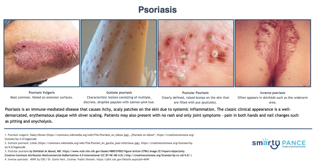 <p>Chronic autoimmune inflammatory skin disease with well-demarcated plaques covered by silver-white scale, classically on extensor surfaces </p><p>-Presentation: Auspitz sign (pinpoint bleeding when scale is removed), Koebner phenomenon, associated with psoriatic arthritis </p><p>-Dx: clinical</p><p>-Tx: topical corticosteroids </p>