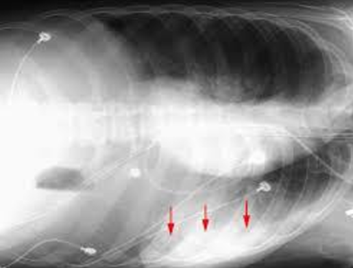<p>Diagnosis of this patient in lateral decubitus.</p>
