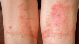 <p>A general term for inflammation of the skin, often causing redness, swelling, and itching.</p>