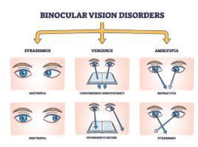 <ul><li><p>requires eyes to work together as a team</p><ul><li><p>if they aren’t fixating on object/target at same place, brain will receive 2 images and perceive it as double </p></li></ul></li><li><p>behaviors that indicate dysfunction </p><ul><li><p>tilting head</p></li><li><p>excessive blinking </p></li><li><p>decreased depth perception </p></li><li><p>closing one eye to see clearly </p></li></ul></li></ul><p></p>