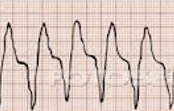 <ul><li><p>what</p><ul><li><p>wide complex tachycardia</p></li><li><p>MEDICAL EMERGENCY due to potential cardiac arrest </p></li></ul></li><li><p>symp: palpitations, SOB, dizziness/lightheadedness, angina, cardiac arrest</p></li><li><p>EKG:</p><ul><li><p>3 or more PVC and HR > 100 bpm </p></li></ul></li></ul><p></p>
