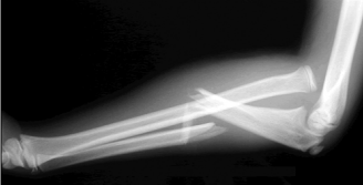 <p>Ulnar fracture with dislocation of the radial head</p>