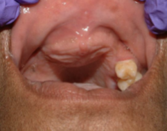 <ol start="76"><li><p>Identify the finding shown.</p></li></ol><p></p>