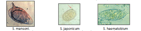<p>INTESTINAL SCHISTOSOMIASIS</p><p>Stool/urine: Identify S. mansoni, (lateral-spined), S. Japonicum (small lateral knob) ova in faeces. S. haemotobium ova (terminal spine) in urine</p><p>.</p><p>Repeated examinations and concentration method required.</p><p>.</p><p>Rectal snip. roctoscopy: take 6 snips of mucosa. Crush between glass slides, microscopy. Eggs of SM, SJ and also SH found.</p><p>.</p><p>Serology: indicates past or present infection. CFT/ELISA. Useful for screening (i.e.tourist visited endemic area and have been exposed but no symptoms).</p><p>.</p><p>Antigen detection in research laboratories identifies LIVING worms. Intestinal schistosomiasis S. mansoni. S. japonicum S. haematobium</p>