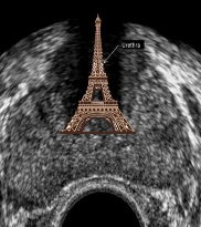 <ol><li><p>Peripheral zone </p></li><li><p>Central and transitional zone </p></li><li><p>Urethra </p></li></ol><p></p>