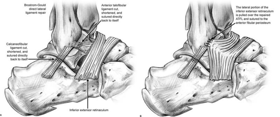 <p></p><ul><li><p>Stabilization Surgery for Chronic Ankle Instability</p></li><li><p>"Pants Over Vest Technique"</p></li><li><p>Remnants of the stretched ligaments are sutured back together</p></li></ul><p></p><p></p>