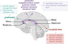 <ul><li><p><span><strong><mark data-color="#6f6c6c" style="background-color: rgb(111, 108, 108); color: inherit;">Genu</mark></strong> — the front end</span></p></li><li><p><span><strong><mark data-color="#6c6969" style="background-color: rgb(108, 105, 105); color: inherit;">Body</mark></strong> — the large middle section</span></p></li><li><p><span><strong><mark data-color="#635e5e" style="background-color: rgb(99, 94, 94); color: inherit;">Splenium</mark></strong> — the rounded back end</span></p></li><li><p><span><strong><mark data-color="#585454" style="background-color: rgb(88, 84, 84); color: inherit;">Rostrum</mark></strong> — a thin projection from the genu, running down and back toward the lamina terminalis</span></p></li></ul><p></p>