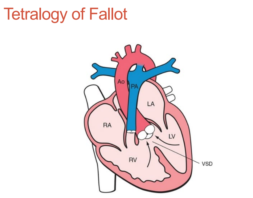 <ol><li><p>Overriding aorta • </p></li><li><p>Malalignment VSD •</p></li><li><p> Infundibular pulmonary stenosis • </p></li><li><p>4th (right ventricular hypertrophy) is not seen in utero</p></li></ol><p></p>