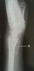 <p>Visualized on lateral view, Located ¼ of an inch anterior to the radius</p>