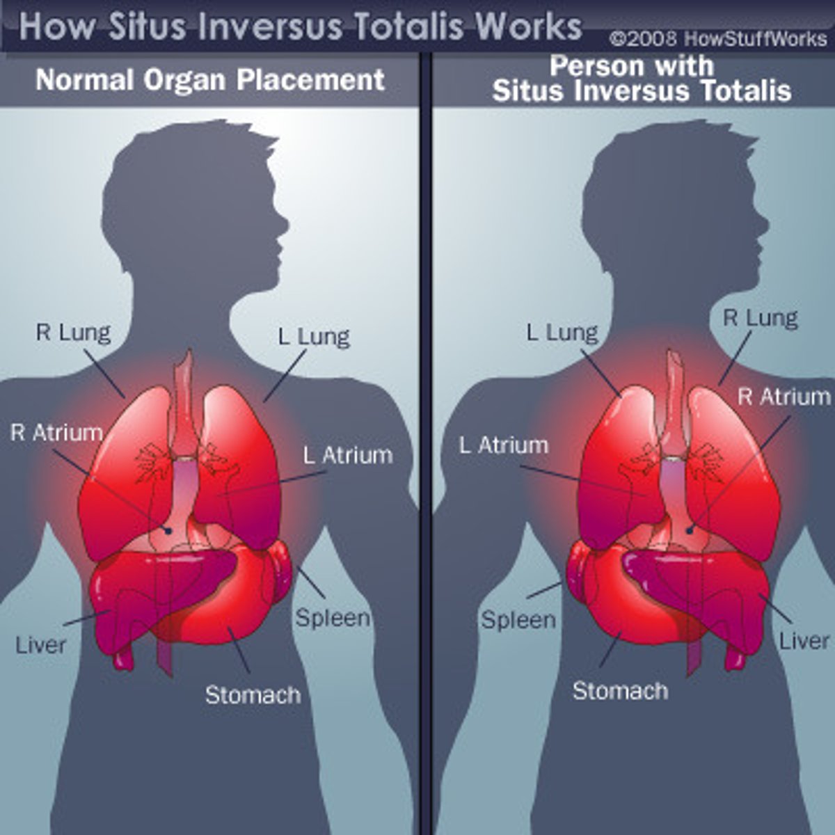 <p>situs inversus</p>