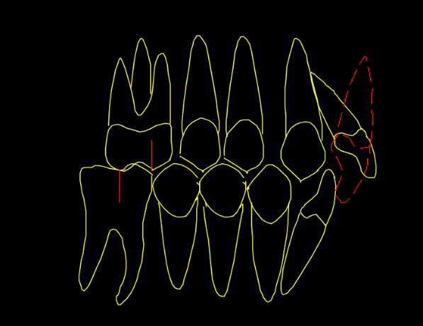 <p>- Maxillary <strong>centrals</strong> are <strong>recumbent</strong> (retrusive + retroclined)</p><p>- Maxillary laterals are procumbent ( proclined)</p>