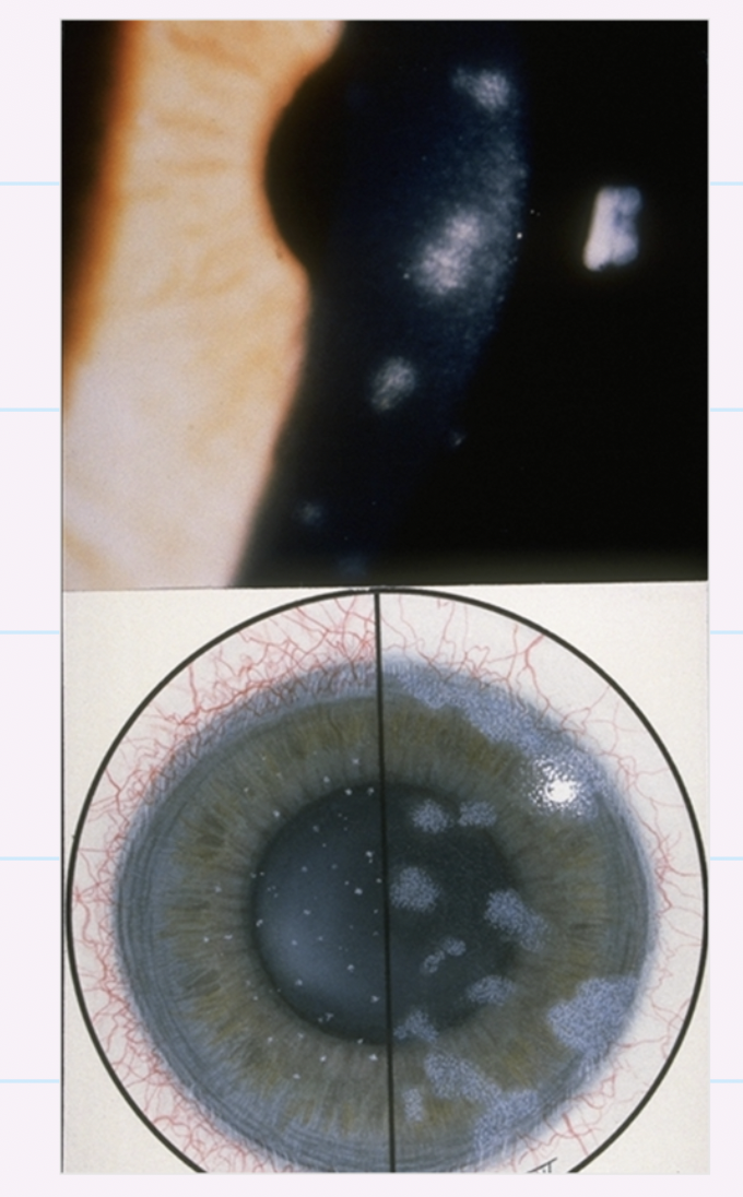 <ul><li><p>Punctate epithelial keratitis </p></li><li><p>Follicular conjunctivitis → upper and lower eyelids </p></li></ul><p></p>