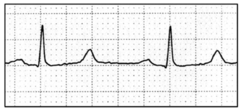 <p>- prolonged ventricular repolarization</p><p>- congenital or acquired</p>