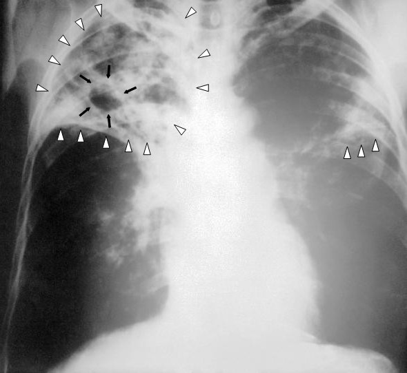 <p>Bacterial infection due to Mycobacterium tuberculosis (acid-fast bacilli)</p><p>-Presentation: fatigue, productive cough, night sweats, weight loss, post-tussive rales </p><p>-RF: endemic area, immunocompromised, recent immigrants, prisoners, healthcare workers</p><p>-Dx: screen with TST or IGRAs but diagnostic is sputum for AFB smears/culture, CXR shows upper cavitary lesions, biopsy shows caseating granulomas </p><p>-Tx: RIPE therapy if active, baseline LFTs required, three months of isoniazid plus rifampin if latent </p>