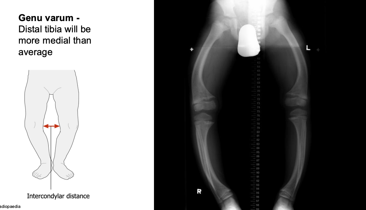 <p>distal tibia is more medial than average, this is normal until 18-24 months of age</p>