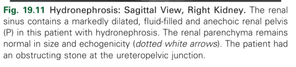 <p>Hydronephrosis</p>